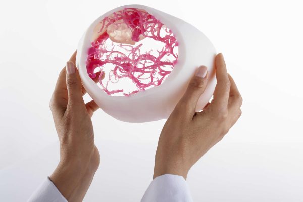 PolyJet support hematoma